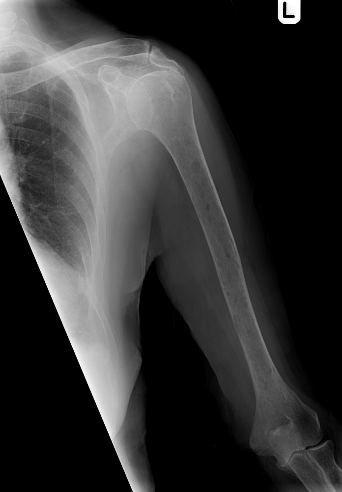 bone-tumours-and-benign-lytic-lesions